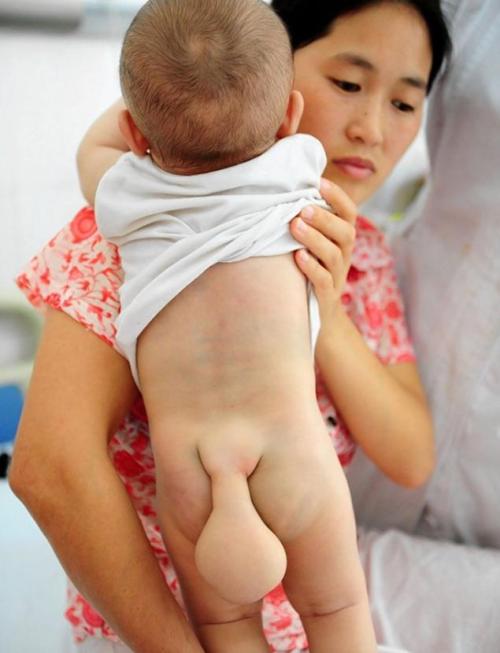 Used Without Permission From: http://www.nydailynews.com/life-style/health/mom-begs-doctors-baby-born-tail-article-1.1379266
